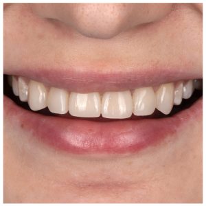 Estetinis plombavimas ant moters priekinių dantų