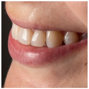 Estetinis plombavimas ant šoninių dantų