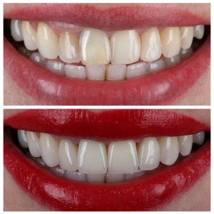 Dantų laminatės ir dantų vainikėliai prieš ir po