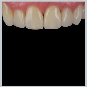 Dantų laminatės po gydymo