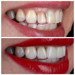 Dantų laminatės prieš ir po ant šoninių dantų