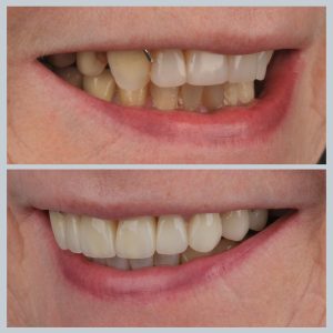 Dantų plokštelė ir dantų laminatės prieš ir po