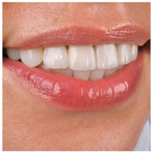 Estetinis plombavimas ant pacientės dantų po dantų tiesinimo