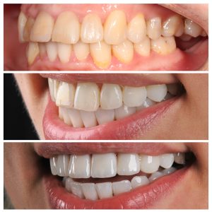 Pacientės dantys skirtingais gydymo etapais iš dešinio šono