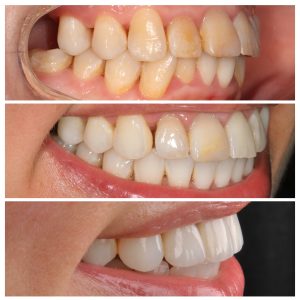 Pacientės dantys skirtingais gydymo etapais iš kairio šono