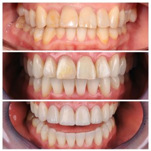 Pacientės dantys skirtingais gydymo etapasi iš priekio