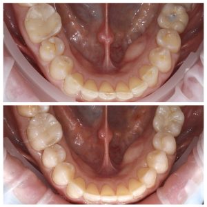 Apatinis dantų lankas prieš ir po plombavimo