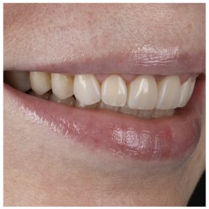 Estetinis plombavimas ant pacientės priekinių dantų