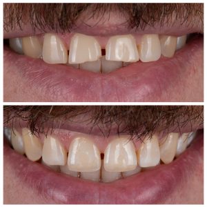 Estetinis plombavimas po dantų traumos