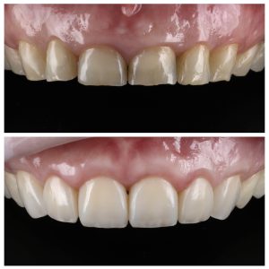 Nudilusių dantų estetinis plombavimas prieš ir po