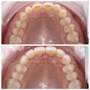 Viršutinis dantų lankas prieš ir po plombavimo