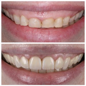 Visų dantų plombavimas prieš ir po