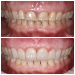 Visų nudilusių dantų plombavimas prieš ir po