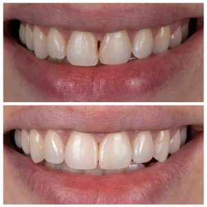 4 priekinių dantų estetinis plombavimas prieš ir po