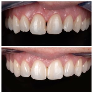 4 priekinių dantų plombavimas prieš ir po