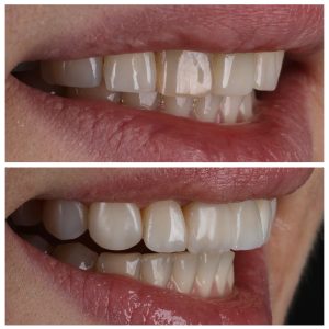 Cirkonio keramika ir estetinis plombavimas prieš ir po gydymo