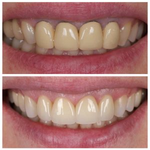 Dantų karūnėlės prieš ir po gydymo