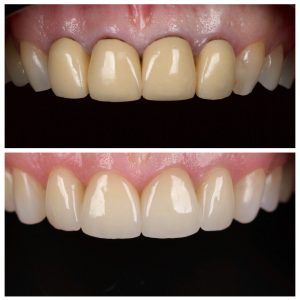 Dantų vainikėliai ant priekinių dantų prieš ir po gydymo