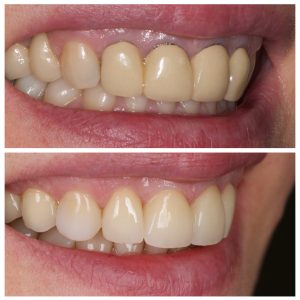 Dantų vainikėliai ir dantų tiltai prieš ir po gydymo
