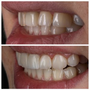 Estetinis plombavimas prieš ir po