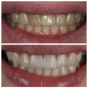 Implantas ir estetinis plombavimas prieš ir po gydymo