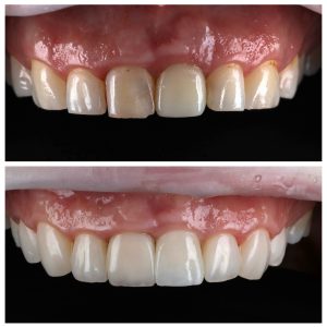 Lūžęs danties vainikas prieš ir po gydymo