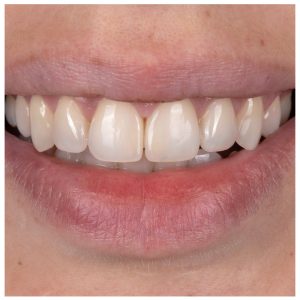 Pacientės šypsena po estetinio plombavimo