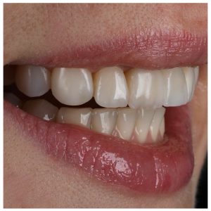 Šypsena po estetinio plombavimo