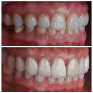 Dantų karūnėlės ant šoninių dantų prieš ir po gydymo