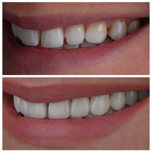 Dantų karūnėlės prieš ir po gydymo