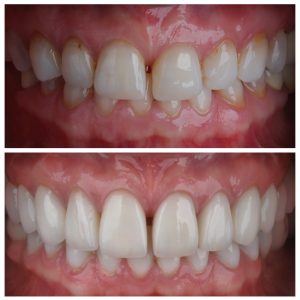 Dantų laminatės ant priekinių dantų prieš ir po gydymo