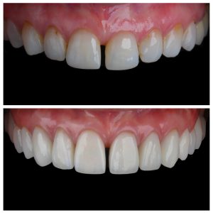 Dantų laminatės prieš ir po gydymo