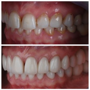 Dantų protezai ant pacientės dantų