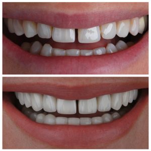 Dantų protezai ir laminatės ant pacientės dantų