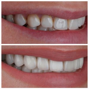 Dantų vainikėlis ir dantų laminatės ant pacientės dantų