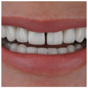 Pacientės šypsena su dantų protezais