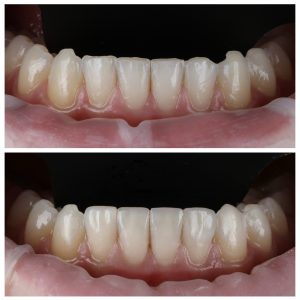 Estetinis plombavimas prieš ir po ant priekinių apatinių dantų