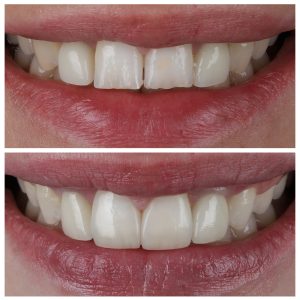 Pacientės dantys po dantų tiesinimo breketais ir dantų protezavimo