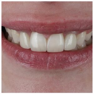 Priekinių dantų implantai ir karūnėlės