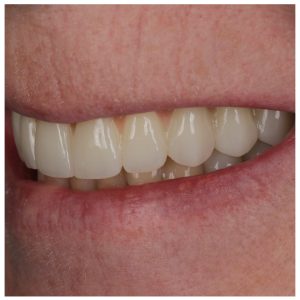 Šypsena su dantų protezu ant 4 implantų