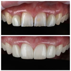Viršutiniai priekiniai dantys prieš ir po breketų ir protezavimo