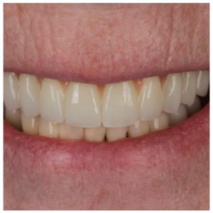 Visi dantys ant 4 implantų