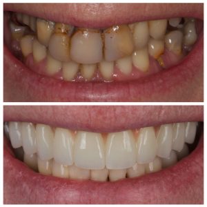 Visi dantys ant 4 implantų prieš ir po gydymo