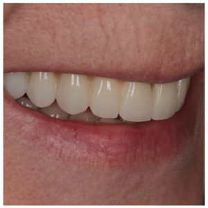 Visų dantų protezai ant 4 implantų