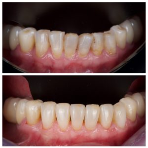 Apatinių dantų estetinis plombavimas prieš ir po