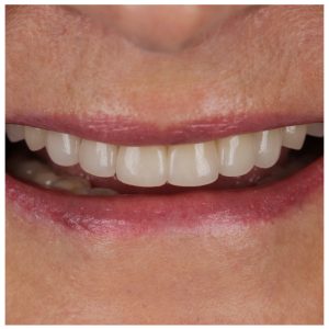 Cirkonio dantys pacientės burnoje