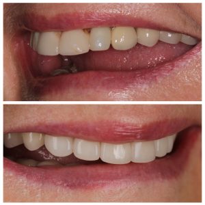 Cirkonio keramika ant šoninių dantų