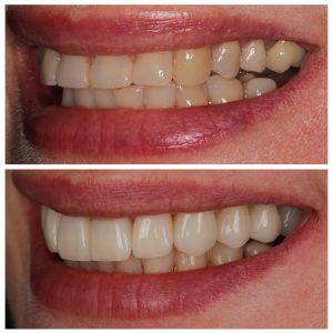 Dantų laminatės ir vainikėliai prieš ir po gydymo