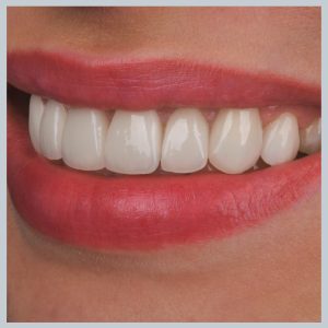 Dantų laminatės po 3 metų