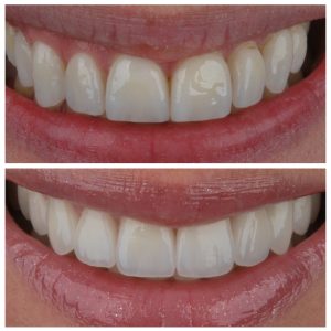 Dantų laminatės prieš ir po